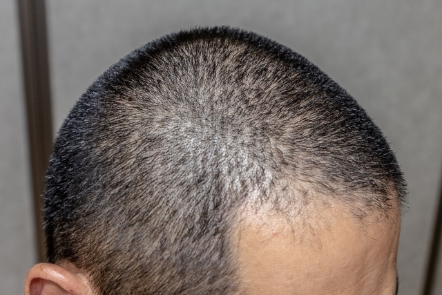 薄毛が坊主を失敗する5つの理由 最適な長さは何ミリなのか徹底検証 Slope スロープ
