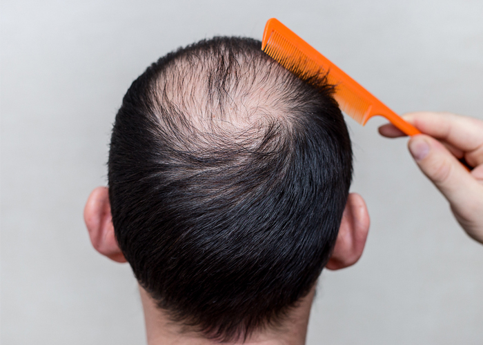 薄毛が坊主を失敗する5つの理由 最適な長さは何ミリなのか徹底検証 Slope スロープ