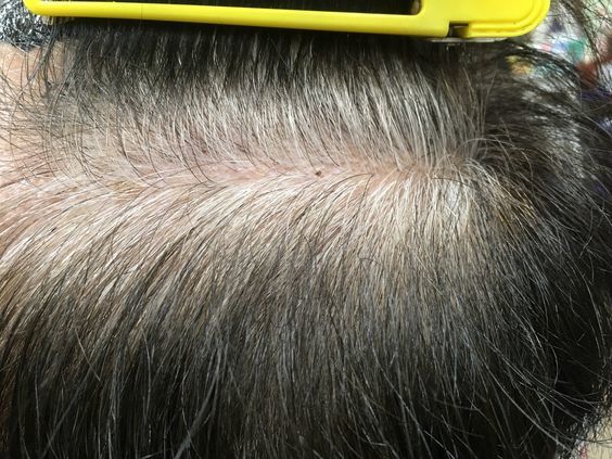 白髪が生える場所には意味あり 病気 頭頂部 後頭部など原因 対策を解説 Slope スロープ